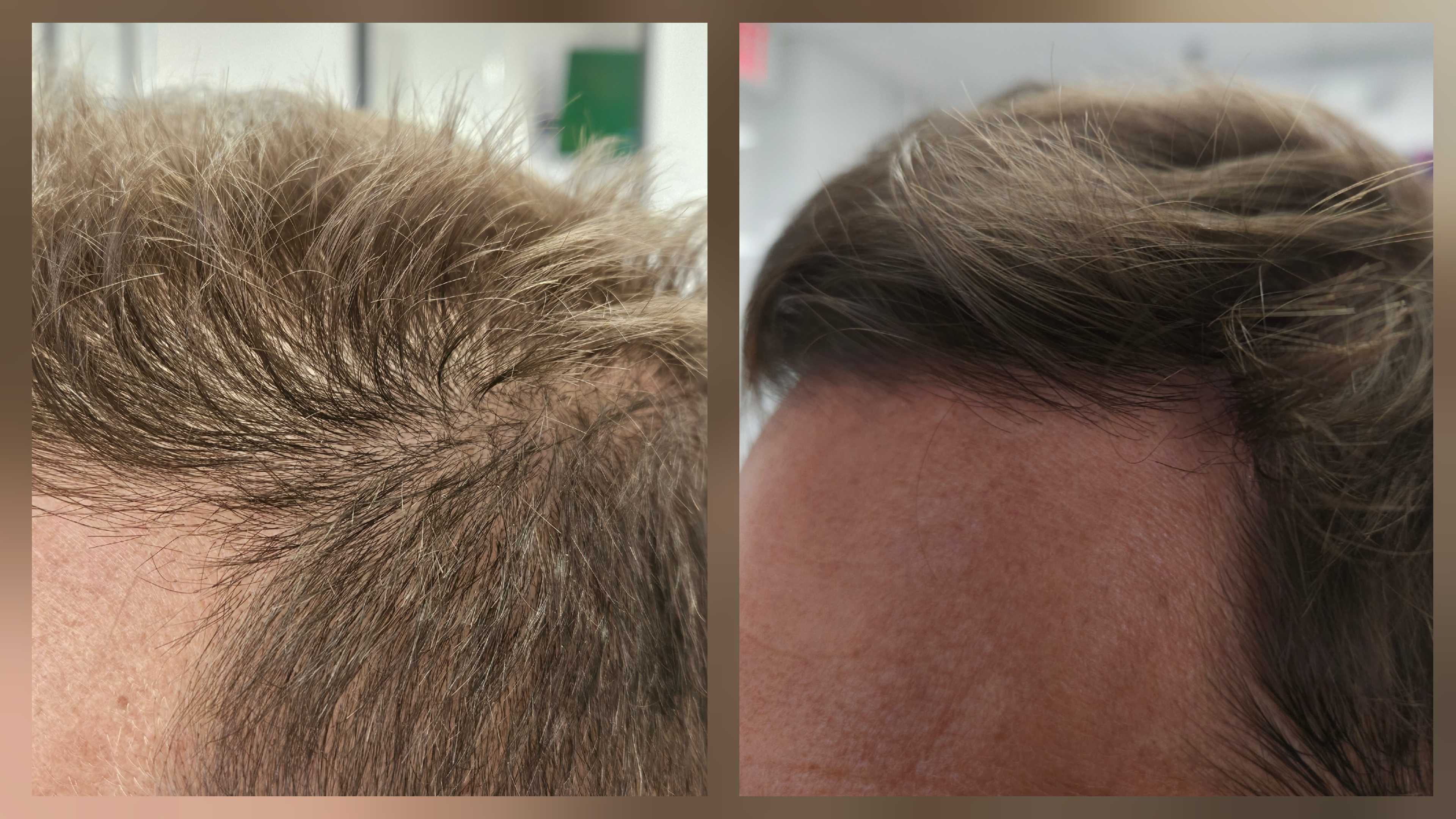 Before and after hair regrowth — NuWav client