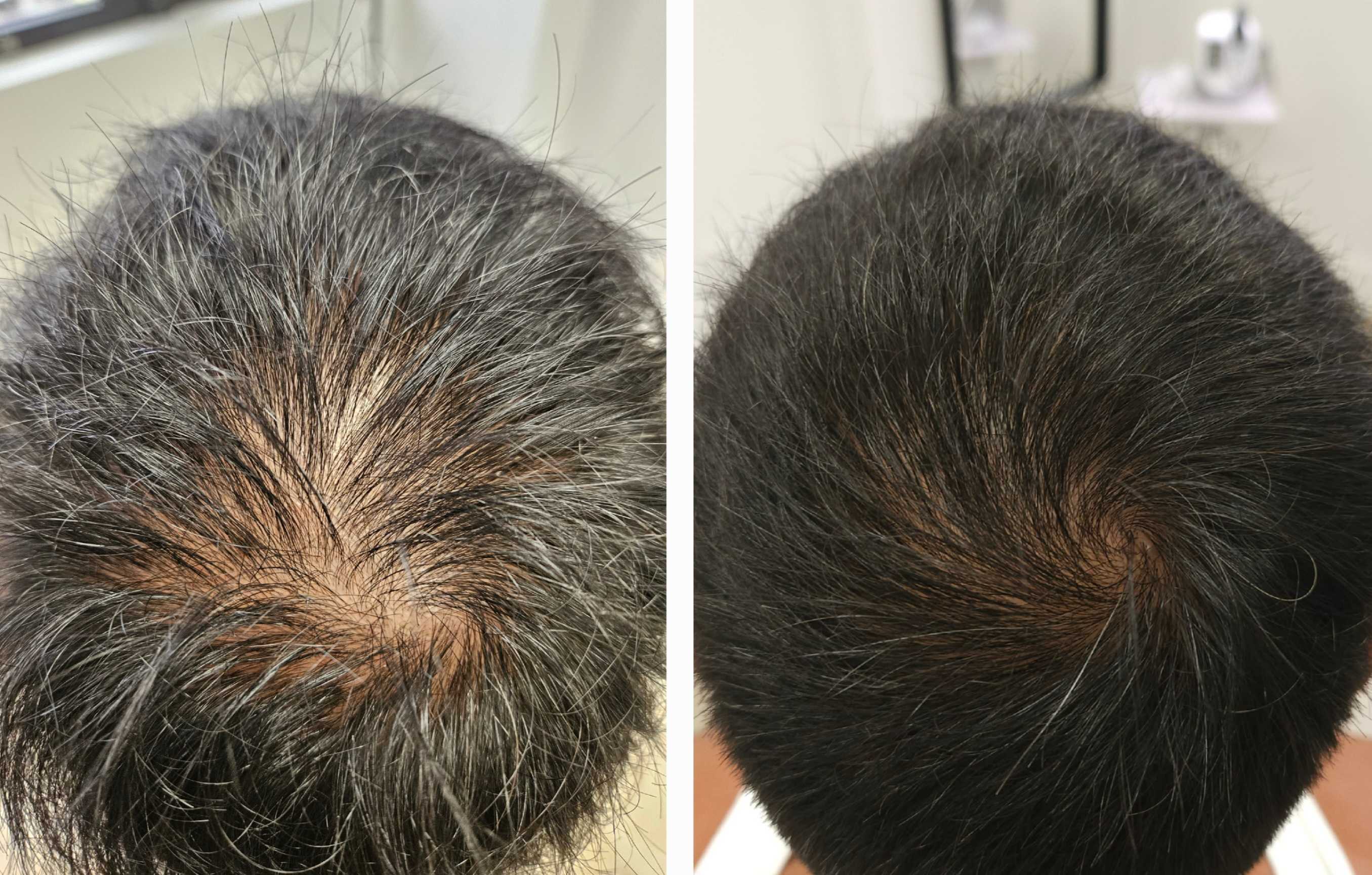 Before and after hair regrowth