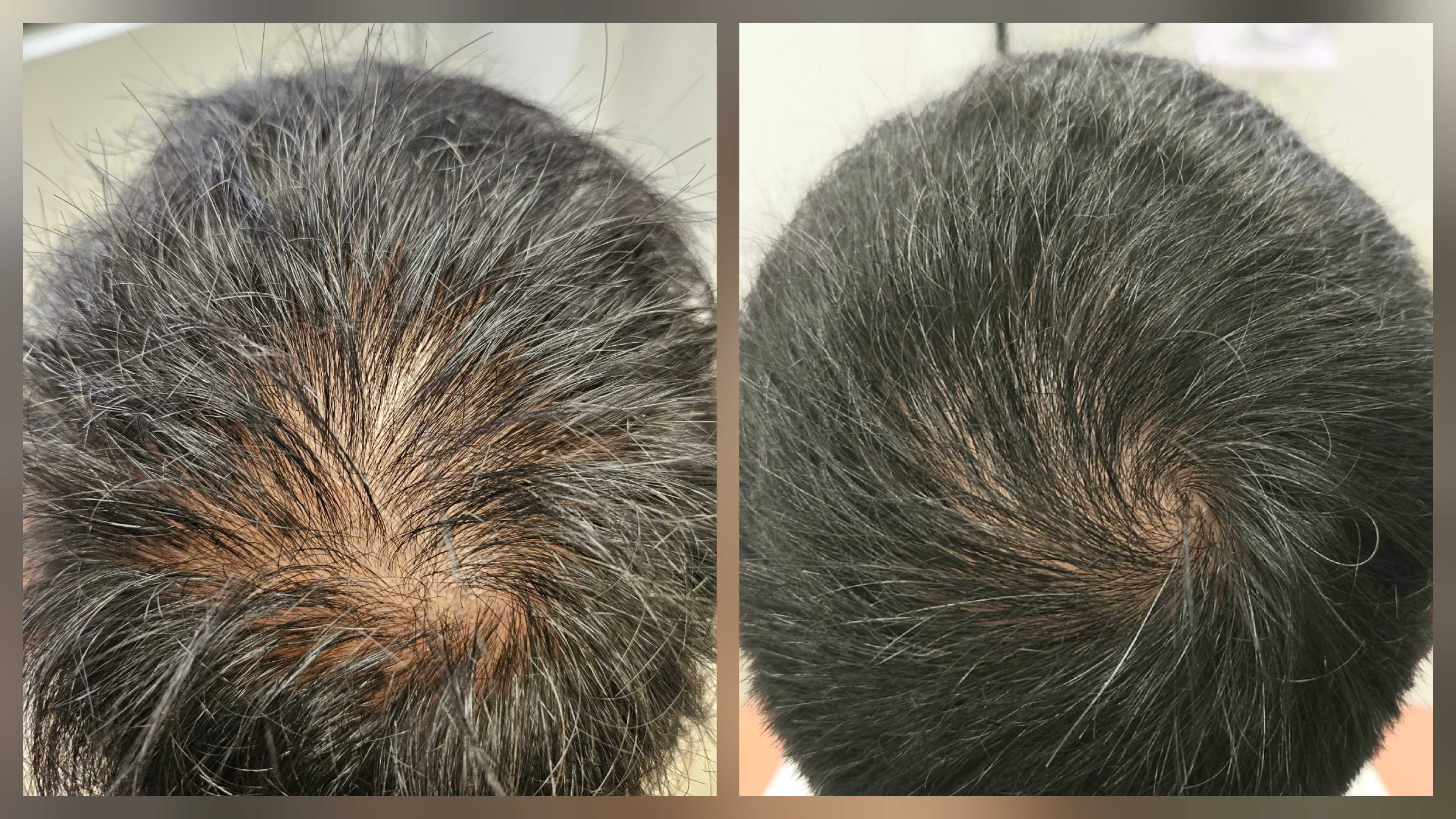 Before and after hair regrowth
