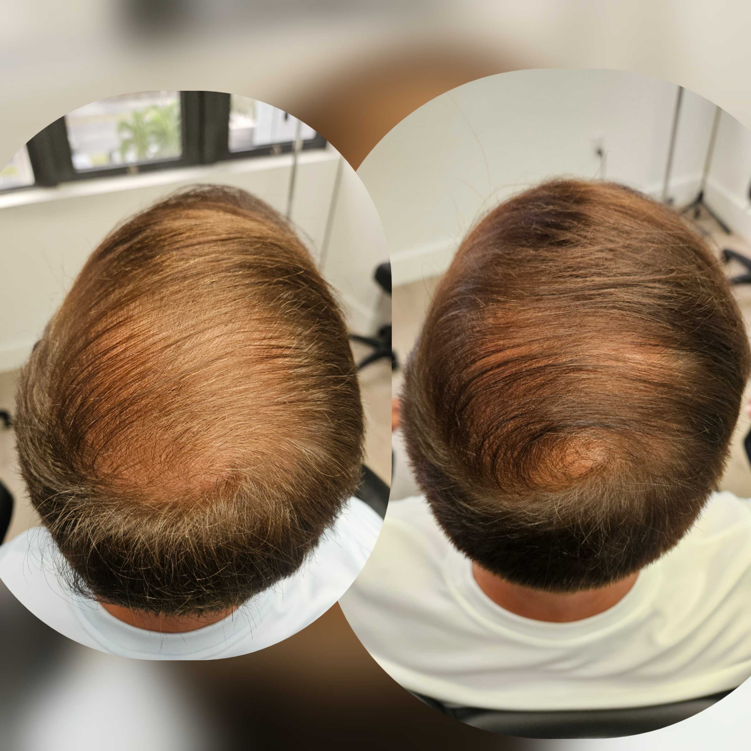 Before and after hair regrowth