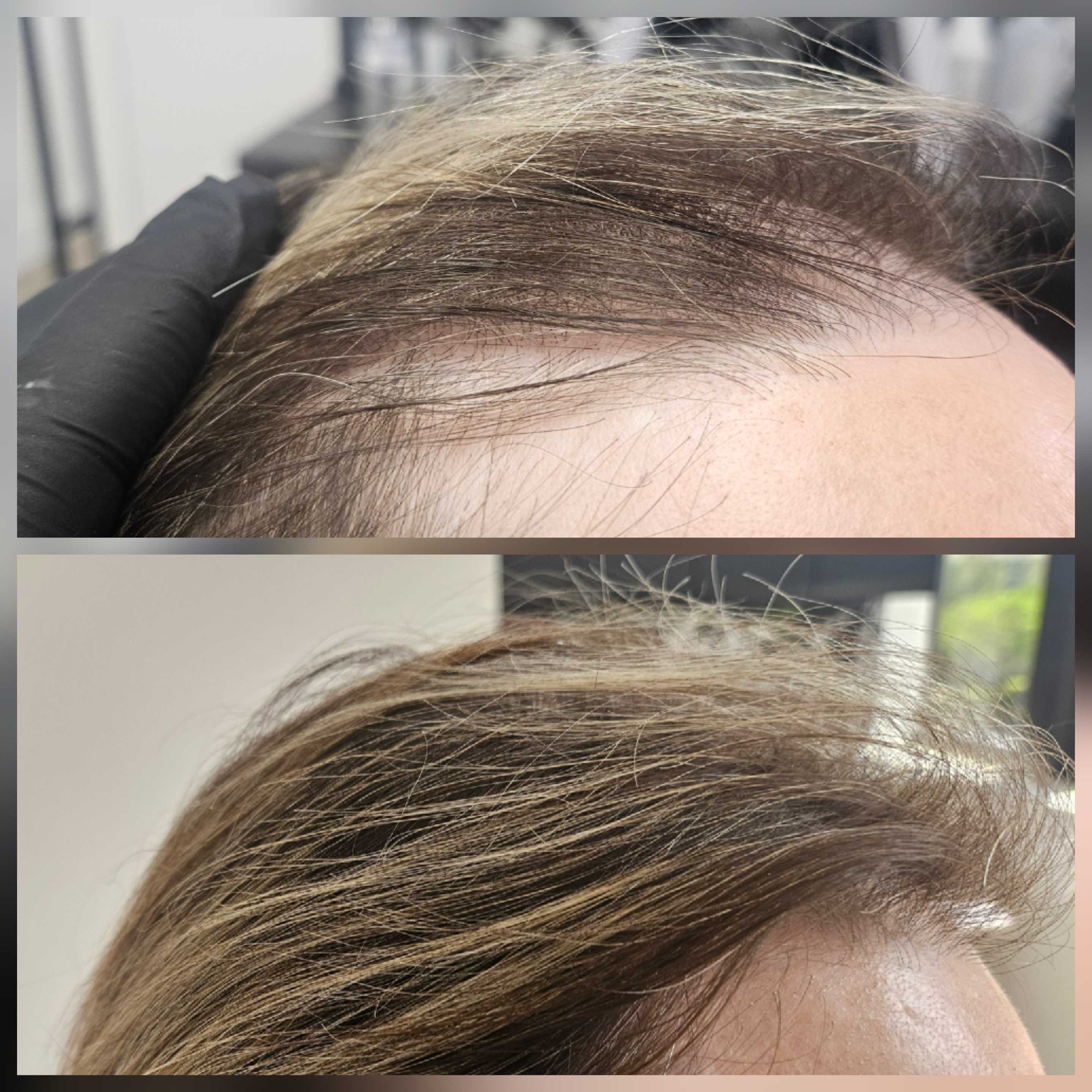 Before and after hair regrowth