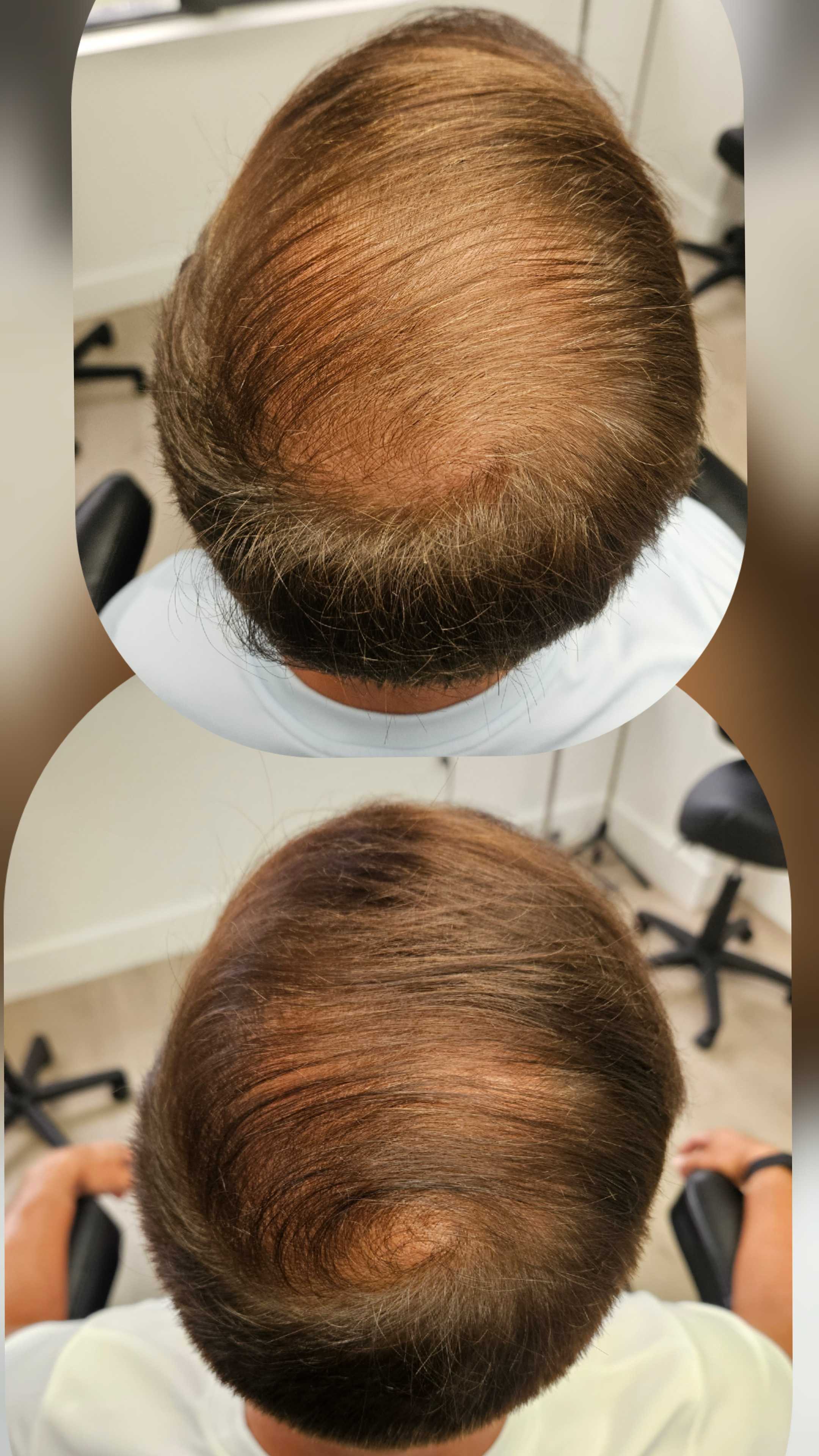 Before and after hair regrowth
